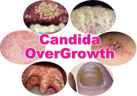 Candida & Fungal Overgrowth