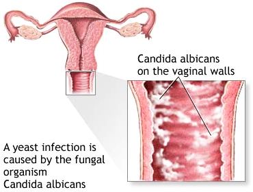 mage result for vaginal candida